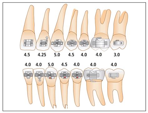 orthodontic bracket positioning chart